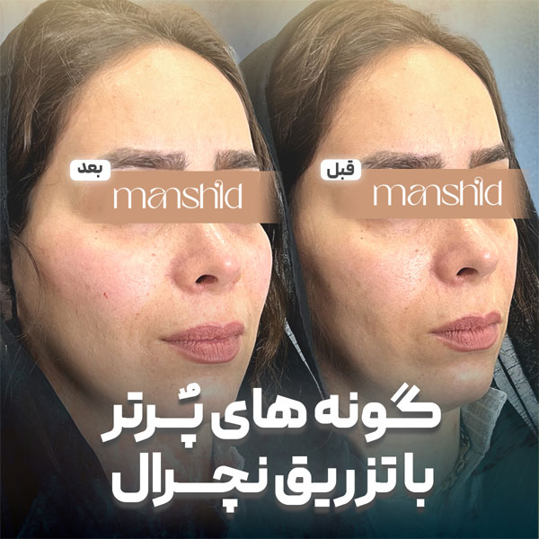 گونه ای پرتر با تزریق نچرال 