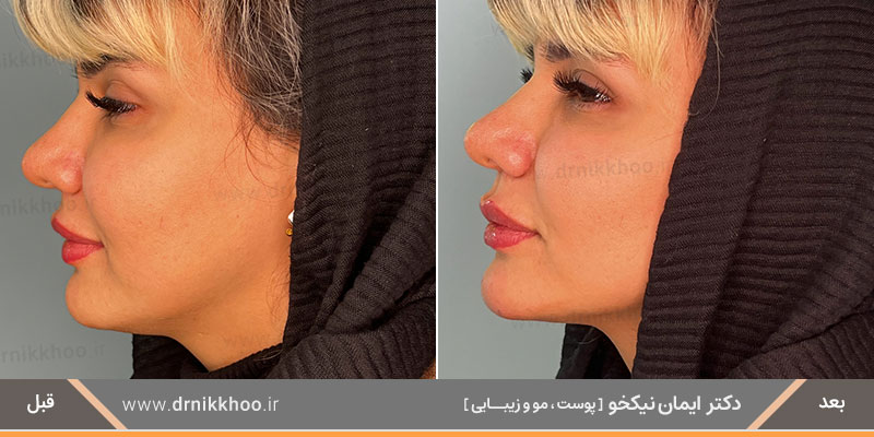 بهبود تقارن و فرم چهره با تزریق ژل به چانه