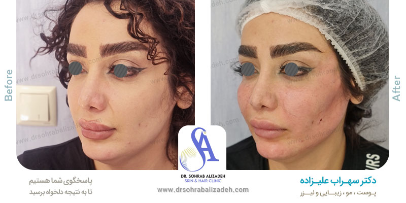 نمونه کار تزریق چربی صورت دکتر علیزاده در اصفهان