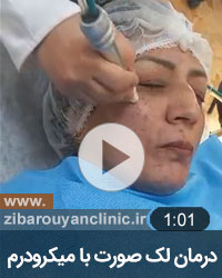 درمان لک صورت با میکرودرم